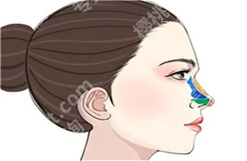 上海时光徐怀河做鼻子怎么样?术前术后恢复图对比!