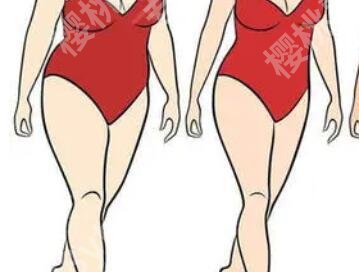 曹栋弼案例吸脂图展示:公布真人吸脂详细过程分享!