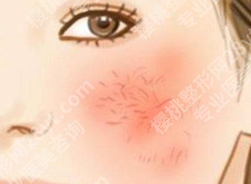 雅漾去红血丝有效吗?红血丝形成原因有哪些?速速了解