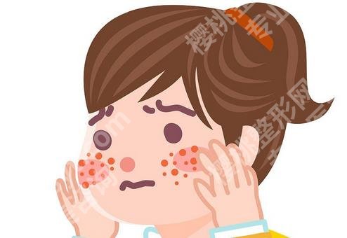 祛痘印好方法有哪些?痘印形成的原因有哪些?进来查看