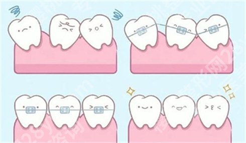 矫正牙齿的佳年龄 是多少岁? 牙齿隐形矫正优势大吗?内幕大揭秘