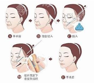 赤峰第二医院拉皮除皱多少钱?价格表_40岁大叔拉皮案例