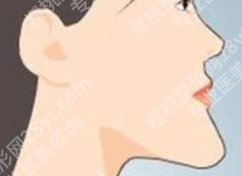 下巴前突怎么办?下巴前突的原因有哪些?速速看介绍