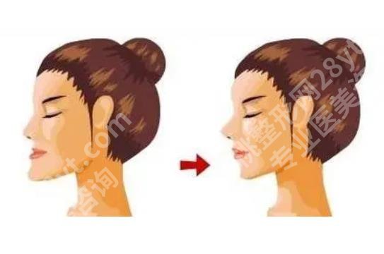 下巴前突怎么办?下巴前突的原因有哪些?速速看介绍