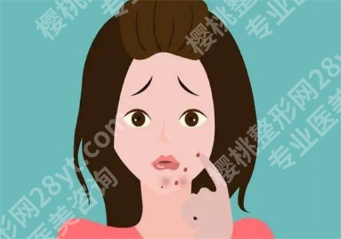 嘴角长痘痘是什么原因?怎么快速消除?饮食怎么控制?一键戳进来了解