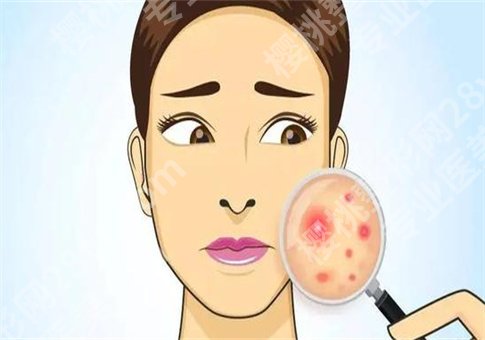嘴角长痘痘是什么原因?怎么快速消除?饮食怎么控制?一键戳进来了解