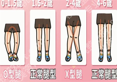如何矫正o型腿?手术矫正o型腿真的可以吗?集合多种解答