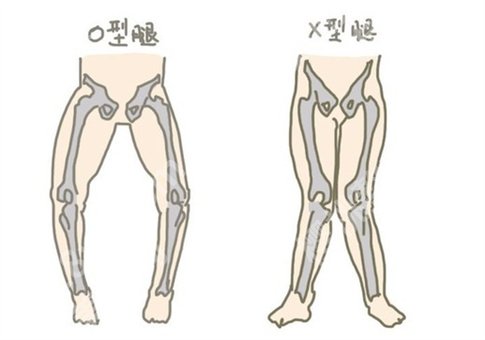 如何矫正o型腿?手术矫正o型腿真的可以吗?集合多种解答