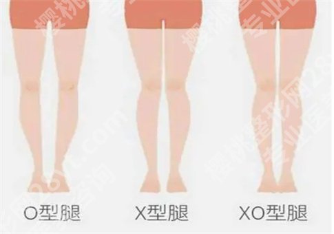 如何矫正o型腿?手术矫正o型腿真的可以吗?集合多种解答