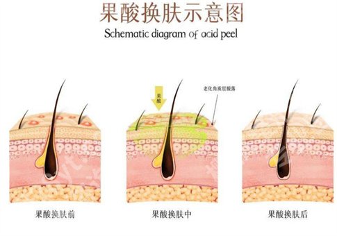 果酸的作用有哪些?操作流程复杂吗?整理相关知识点