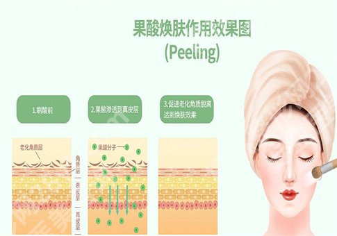 果酸的作用有哪些?操作流程复杂吗?整理相关知识点