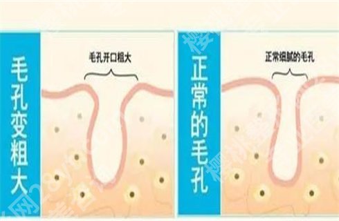 毛孔粗大怎么办?小妙招解答,一篇文章了解详情!
