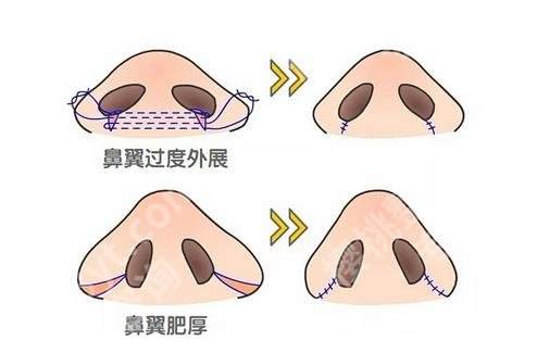 经常笑鼻翼会变大吗 ?鼻翼缩小手术有哪些作用?