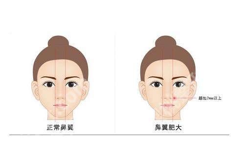 经常笑鼻翼会变大吗 ?鼻翼缩小手术有哪些作用?