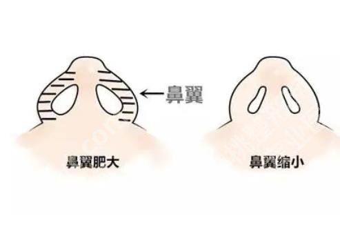经常笑鼻翼会变大吗 ?鼻翼缩小手术有哪些作用?