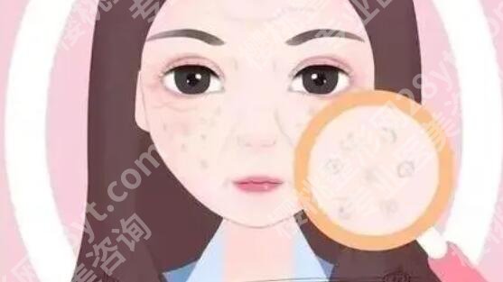 t区毛孔粗大怎么改良?费用大约是多少?来看详细介绍!