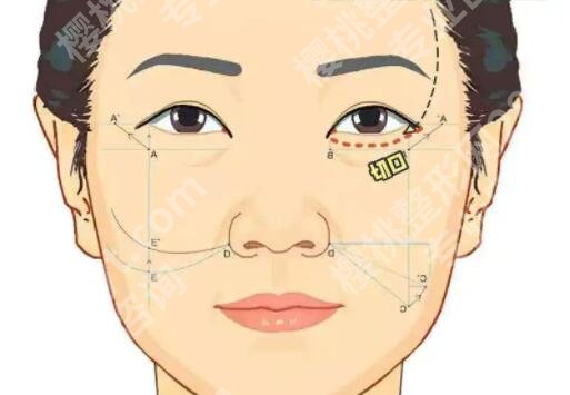 什么是筋膜悬吊面部提升术?原理及费用介绍!收藏再看