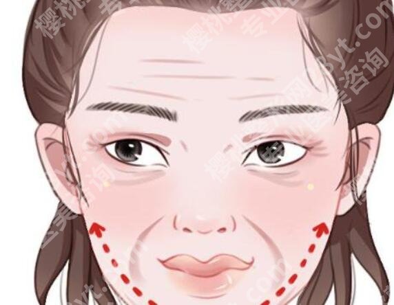 玻尿酸填充会移位吗?术后大概需要多久恢复?