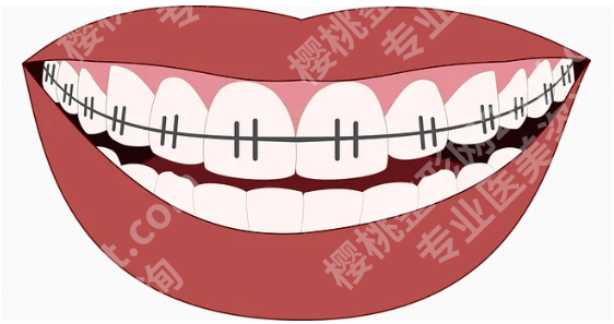 12岁儿童牙齿矫正费用多少?矫正方式包括传统的金属托槽矫正和隐形矫正是好方法!