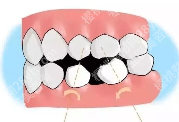 大牙烂了只剩一点空壳了怎么办？牙医会推荐适合你的修复方案！