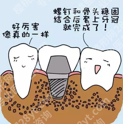 济南种牙多少钱一颗啊?多颗种牙价格和单颗牙的价格是不一样的!