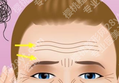 额头填充能维持多长时间?详细科普知识盘点