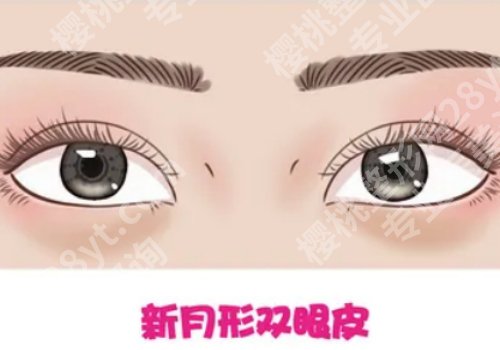 无痕翘睫法双眼皮永久保持吗?维持时间及相关知识盘点