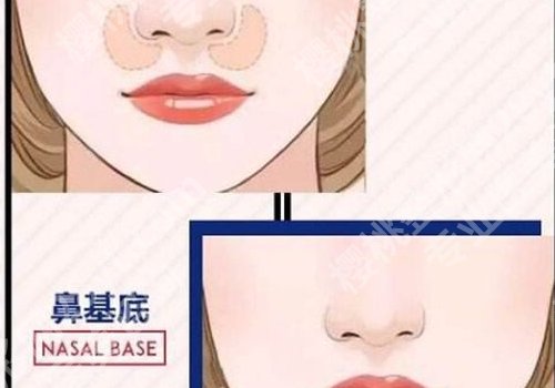 垫鼻基底前后对比照,变化竟然这么大!