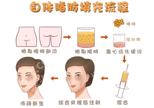 面颊凹陷怎么恢复饱满?这些方法你知道吗?