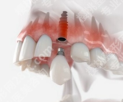 缺牙好的补牙方式？定制义齿、牙桥、种植牙值得选择！