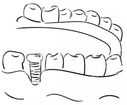 缺一颗牙是镶牙好还是种牙好？种牙和镶牙哪个方式好？