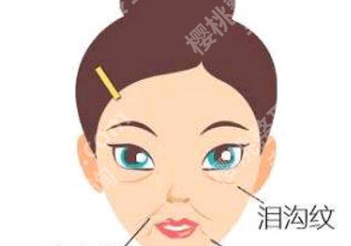 双美胶原蛋白填充泪沟能维持多久?做好护理时间维持更久