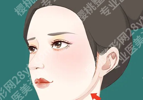 轮廓固定就是填充吗?手术包含哪些部位?术后注意什么?