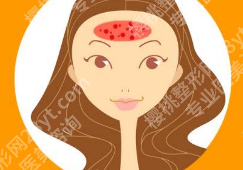 发际线附近长痘痘是啥原因?怎么消除呢?