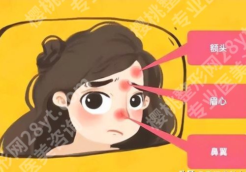 发际线附近长痘痘是啥原因?怎么消除呢?