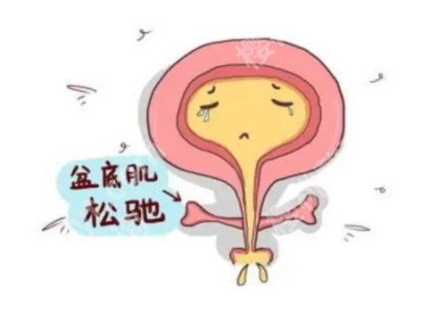 盘底肌修复有哪些方式?这篇内容有你想了解的信息!