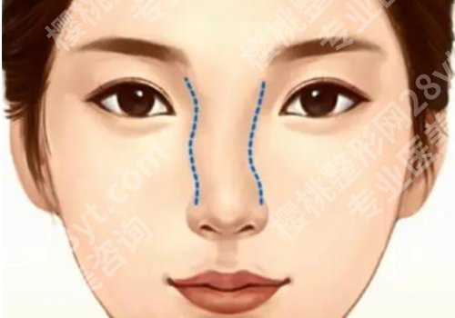 歪鼻矫正要多少钱?所受到的影响因素有哪些?