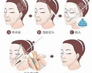 筋膜悬吊面部提升和线雕哪个好?主要的区别是什么呢?价格表