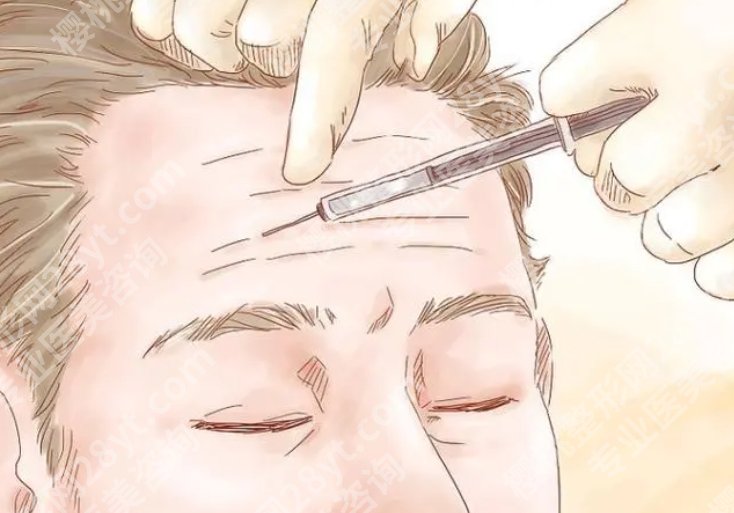 抬头纹怎么去除有效男生|注射除皱效果可靠吗?收费表曝光