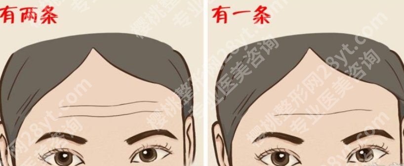 抬头纹怎么去除有效男生|注射除皱效果可靠吗?收费表曝光