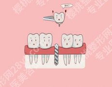 种牙齿一颗要多久？初步评估和调节规划到术后修复和恢复需要很长时间的！