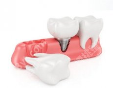 种植牙可以管一辈子吗？可能影响种植牙寿命的因素有哪些？