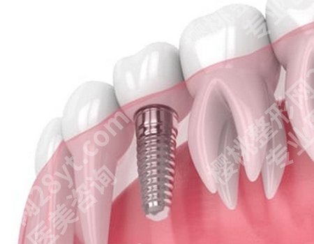 种植牙与镶牙的区别有哪些？适用情况、持久性和稳定性等方面有一些区别！