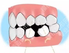 做牙冠什么材质的比较好？达到佳的修复效果和口腔健康！
