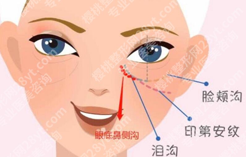 印第安纹怎么去除效果好?术后大约能维持多久?