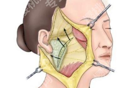面部外轮廓固定怎么做？手术原理及注意事项汇总！