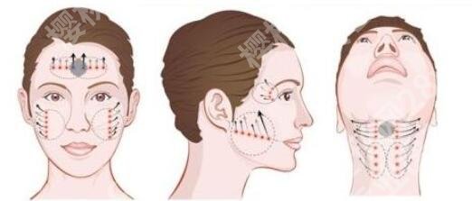 面部外轮廓固定怎么做？手术原理及注意事项汇总！