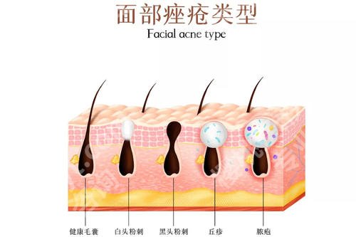 额头长了很多密密麻麻的小痘痘是什么原因?要怎么护理?