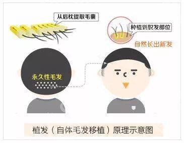 5000个毛囊植发的价格是多少?植发原理、注意事项等盘点!