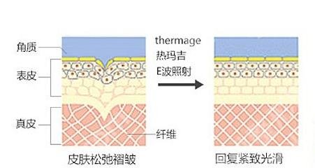 热玛吉一次多少钱?价格费用明细、功效作用揭晓!